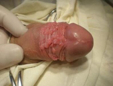 Kide baten papilloma