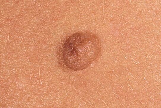 Papiloma sinplea