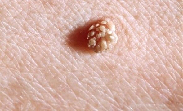 Papilloma giza gorputzean